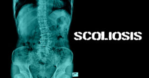 Health House Clinics Scoliosis