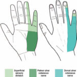 Nerve Entrapments: Upper Limb/Extremities - Health House Clinics